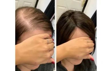 Fastest Way to Regrow Hair Naturally in just 3 Weeks