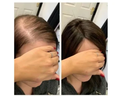 Fastest Way to Regrow Hair Naturally in just 3 Weeks